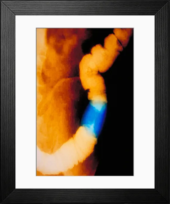 Framed Print : Abdomen X-Ray of colon cancer Framed Print : Abdomen X-Ray of colon cancer