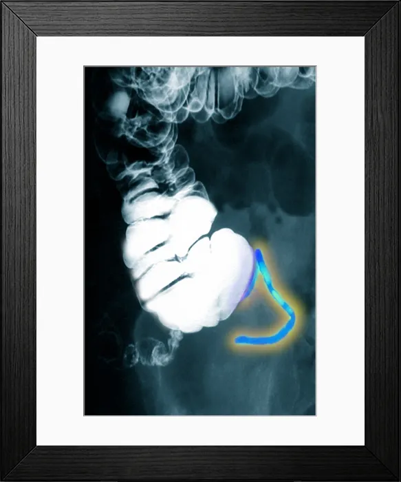 Framed Print : Appendix x-ray with barium contrast