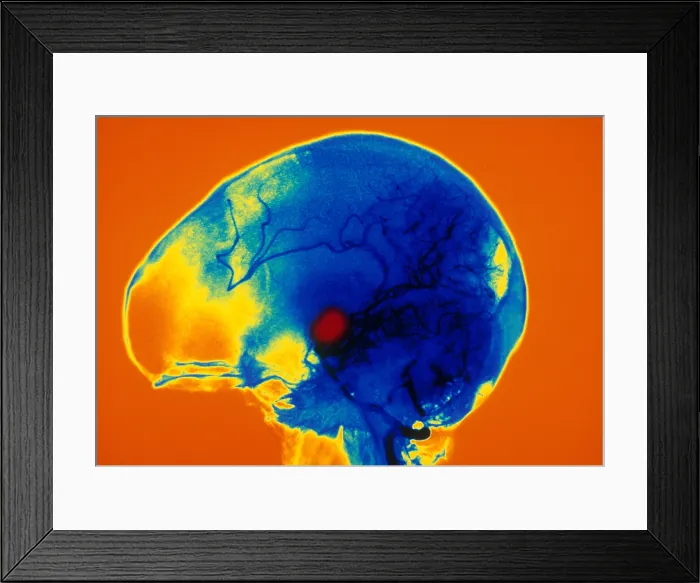 Framed Print : Aneurysm. Cerebral angiogram showing aneurysm of left vertebral artery Framed Print : Aneurysm. Cerebral angiogram showing aneurysm of left vertebral artery