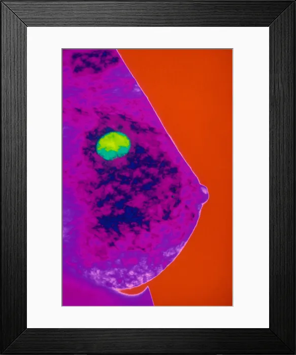 Framed Print : Mammogram. Color enhanced mammogram showing benign cyst