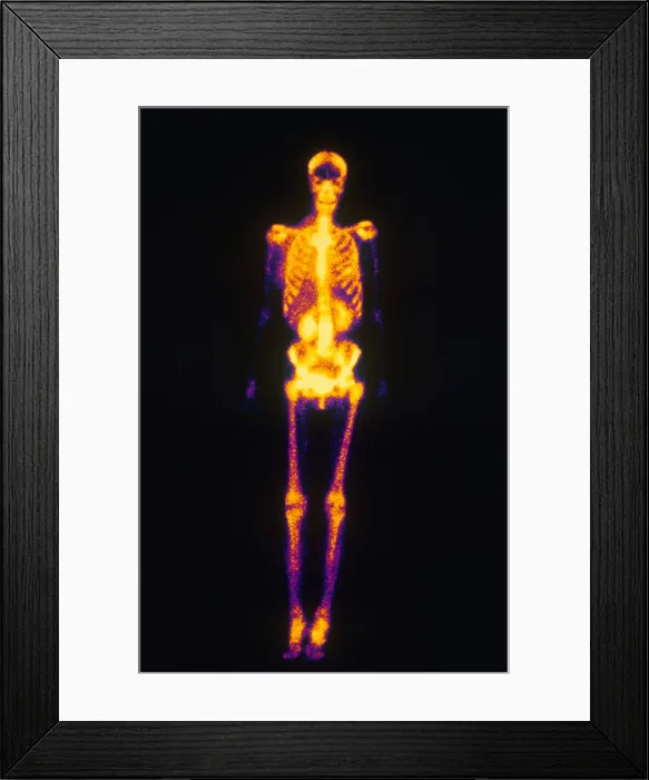 Framed Print : Normal Bone Scan Framed Print : Normal Bone Scan