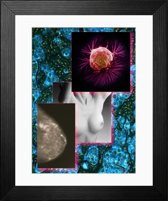 Framed Print : Breast Cancer Montage Framed Print : Breast Cancer Montage
