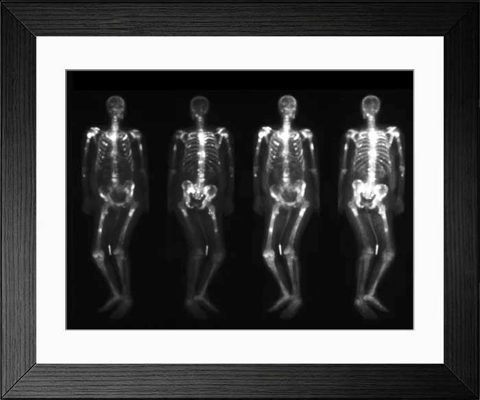 Framed Print : Bone scan showing multiple metastases Framed Print : Bone scan showing multiple metastases