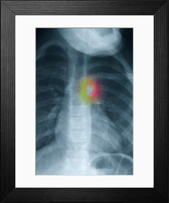 Framed Print : Atrial Septal Defect Treatment