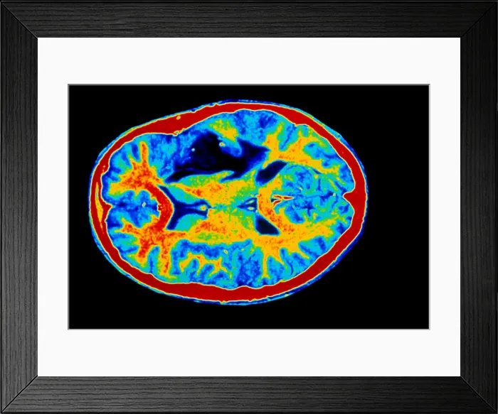 Framed Print : Colored MRI scan of brain cancer Framed Print : Colored MRI scan of brain cancer