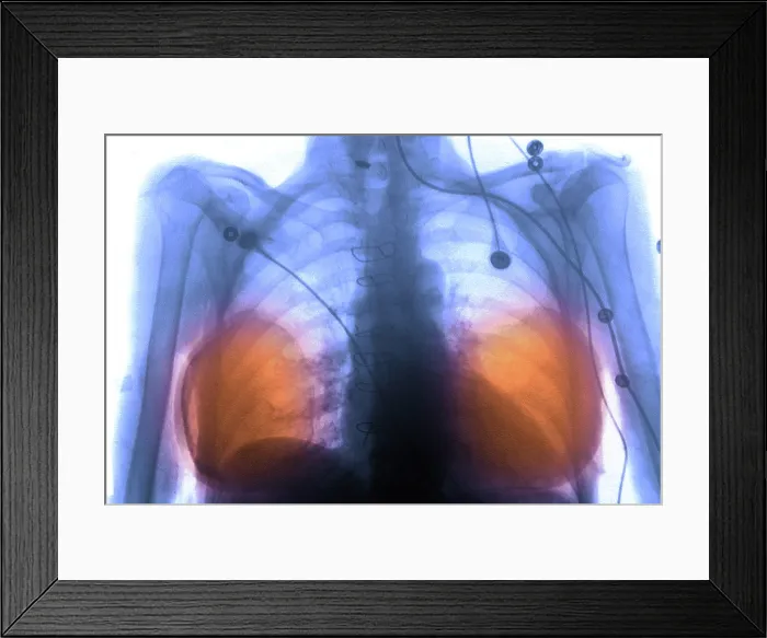 Framed Print : Breast Implants Framed Print : Breast Implants