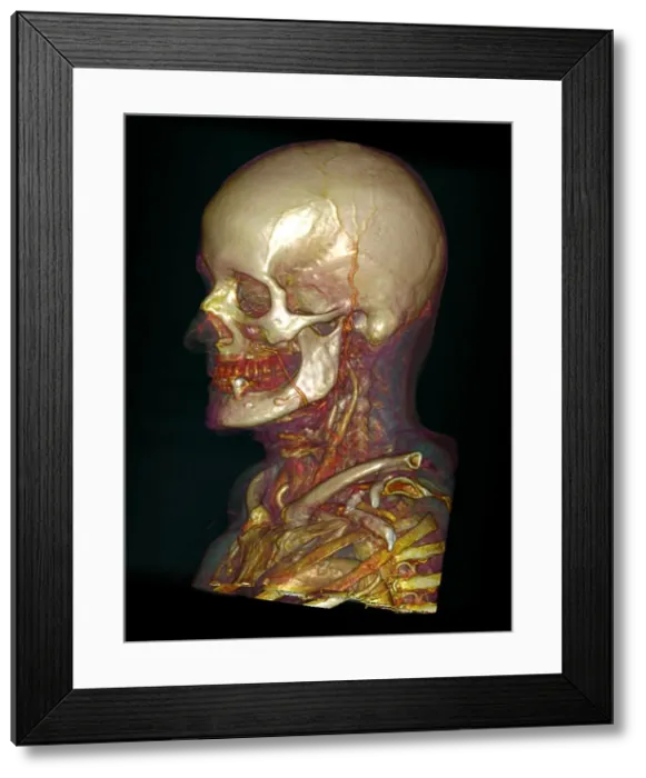 Framed Print : Male Skull & Arterial System Framed Print : Male Skull & Arterial System