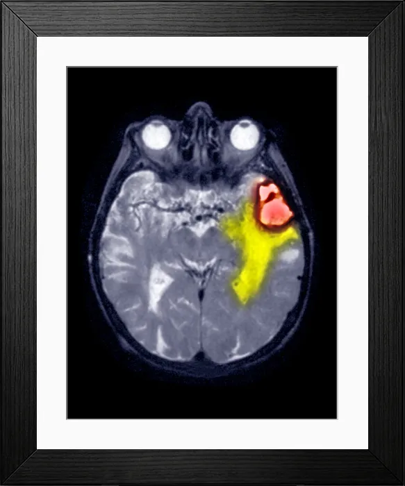 Framed Print : MRI Scan of a Brain Hemorrhage