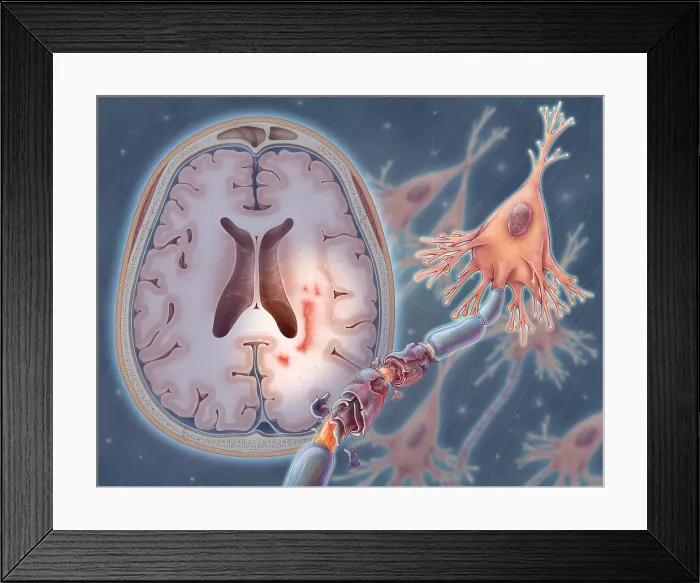 Framed Print : Multiple Sclerosis