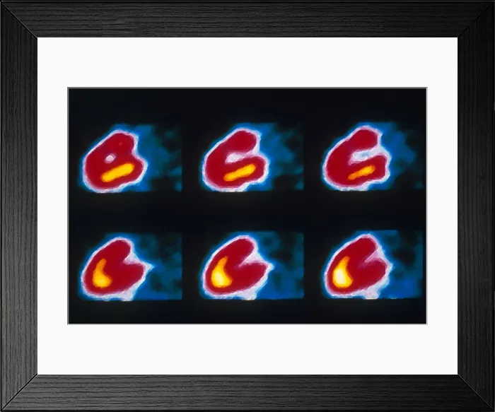 Framed Print : Coronary Heart Disease Framed Print : Coronary Heart Disease