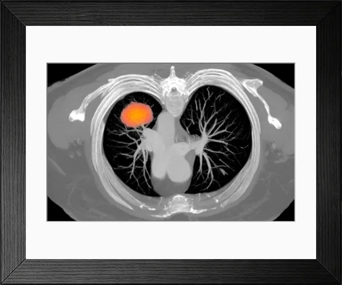Framed Print : Lung Cancer, CT Scan Framed Print : Lung Cancer, CT Scan