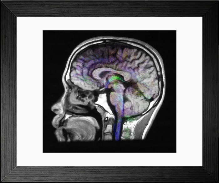 Framed Print : Normal Brain, Fiber Tractography and MRI Framed Print : Normal Brain, Fiber Tractography and MRI