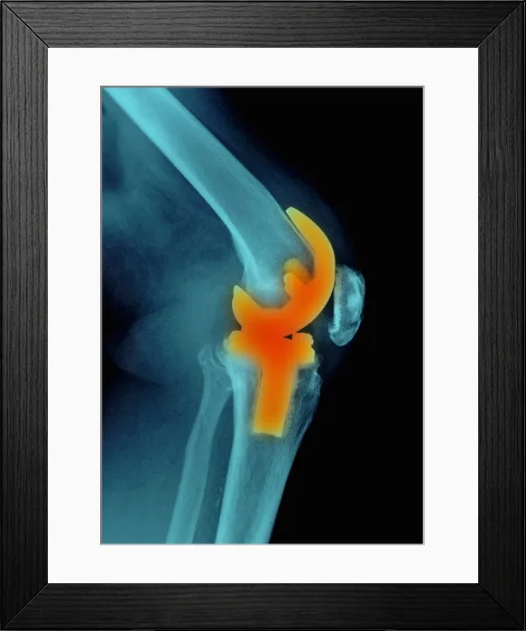 Framed Print : Knee Replacement, X-ray Framed Print : Knee Replacement, X-ray