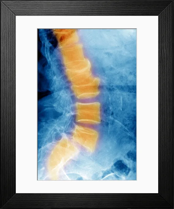 Framed Print : Spondylolisthesis Framed Print : Spondylolisthesis