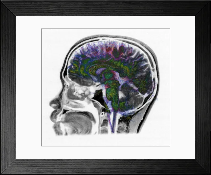 Framed Print : Normal Brain, Fiber Tractography and MRI Framed Print : Normal Brain, Fiber Tractography and MRI