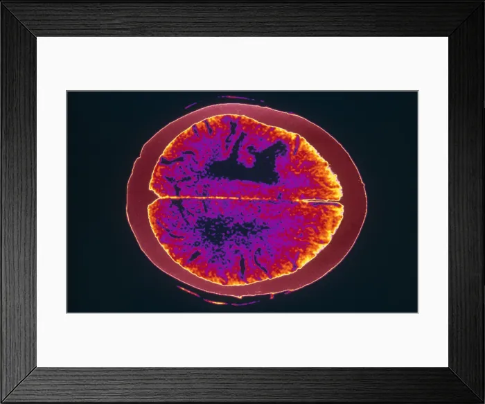 Framed Print : Brain Cancer & Edema, CT Scan