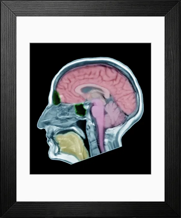 Framed Print : Normal Adult Male Brain, MRI Framed Print : Normal Adult Male Brain, MRI