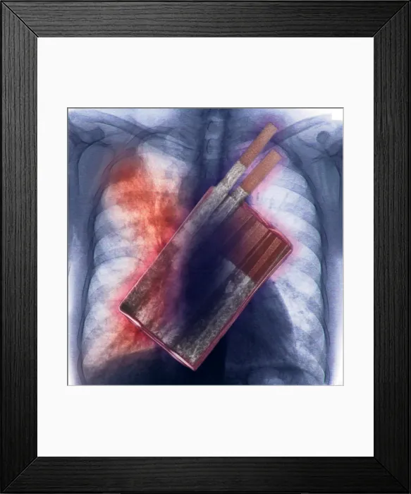 Framed Print : Cigarettes and Lung Cancer Framed Print : Cigarettes and Lung Cancer
