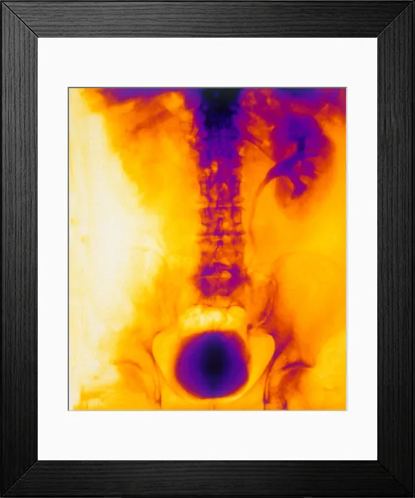 Framed Print : Blocked, Dilated Uterer (Kidney Stone) Framed Print : Blocked, Dilated Uterer (Kidney Stone)