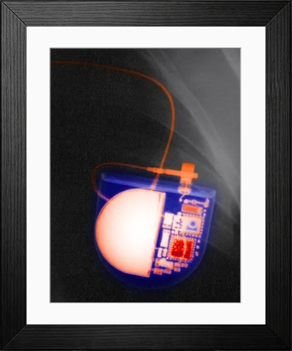 Framed Print : Pacemaker. Color enhanced x-ray of a pacemaker placed in a Bolivian patient Framed Print : Pacemaker. Color enhanced x-ray of a pacemaker placed in a Bolivian patient