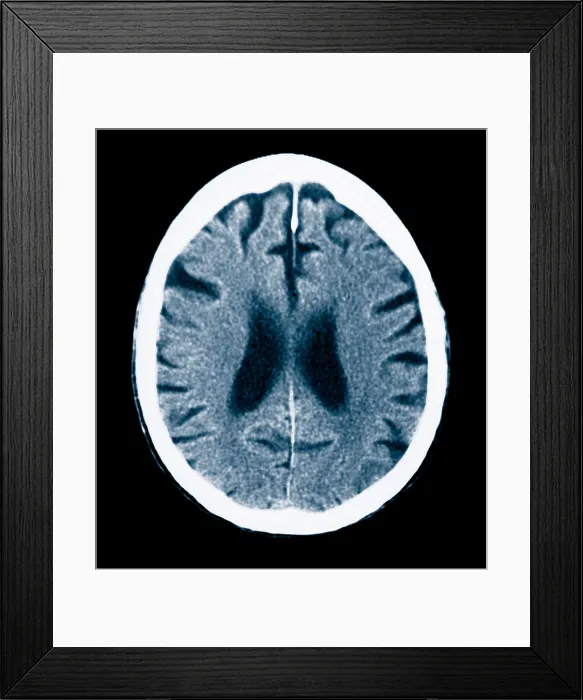 Framed Print : Brain of Alzheimer's Patient, CT Scan Framed Print : Brain of Alzheimer's Patient, CT Scan
