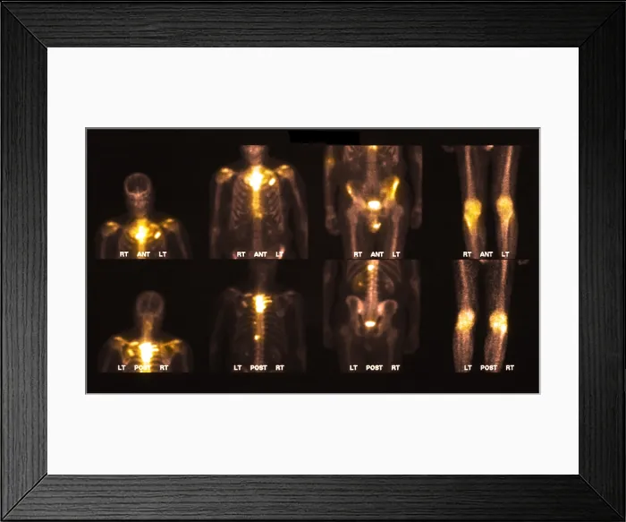 Framed Print : Bone scan showing multiple metastases Framed Print : Bone scan showing multiple metastases