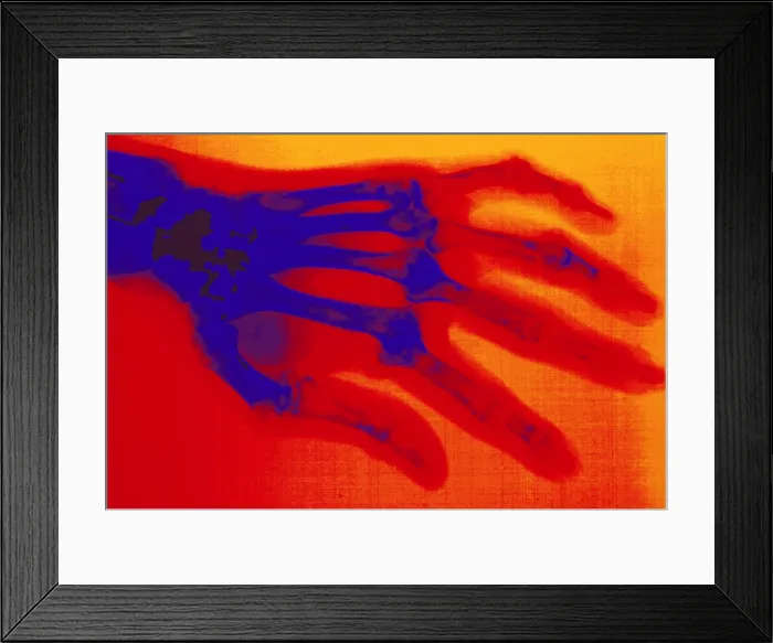 Framed Print : X-ray of hand with rheumatoid arthritis Framed Print : X-ray of hand with rheumatoid arthritis