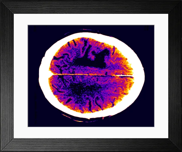 Framed Print : Brain edema Framed Print : Brain edema