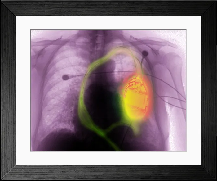 Framed Print : Pacemaker Defibrillator Framed Print : Pacemaker Defibrillator