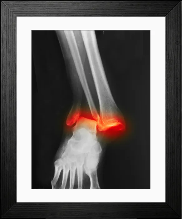 Framed Print : Fractured and Dislocated Ankle Framed Print : Fractured and Dislocated Ankle