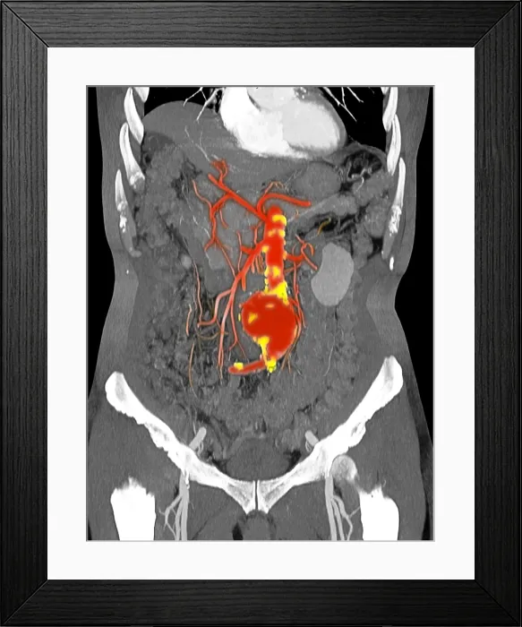 Framed Print : CT Scan of Abdominal Aortic Aneurysm