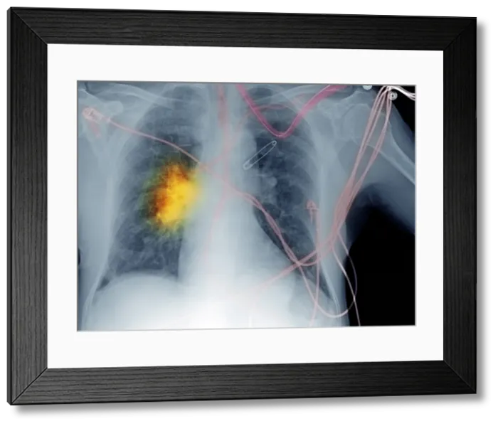 Framed Print : X-ray, Smoker's Chest Framed Print : X-ray, Smoker's Chest