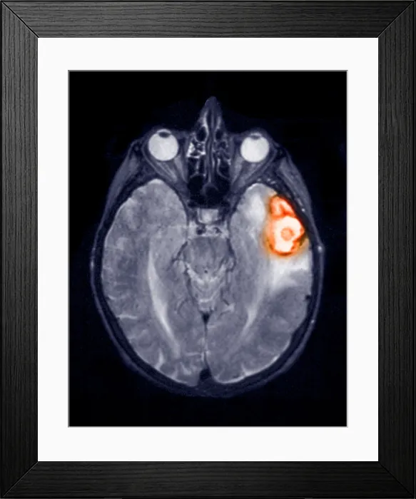 Framed Print : Temporoparietal brain hemorrhage, MRI Framed Print : Temporoparietal brain hemorrhage, MRI