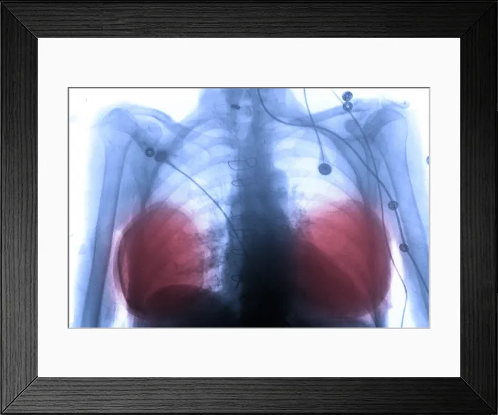 Framed Print : Silicone breast implants