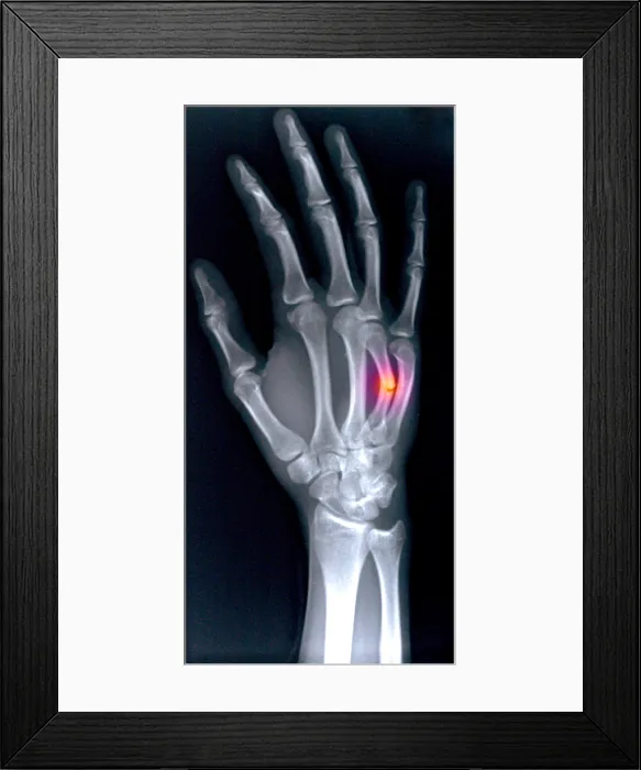 Framed Print : Fractured Metacarpal Framed Print : Fractured Metacarpal