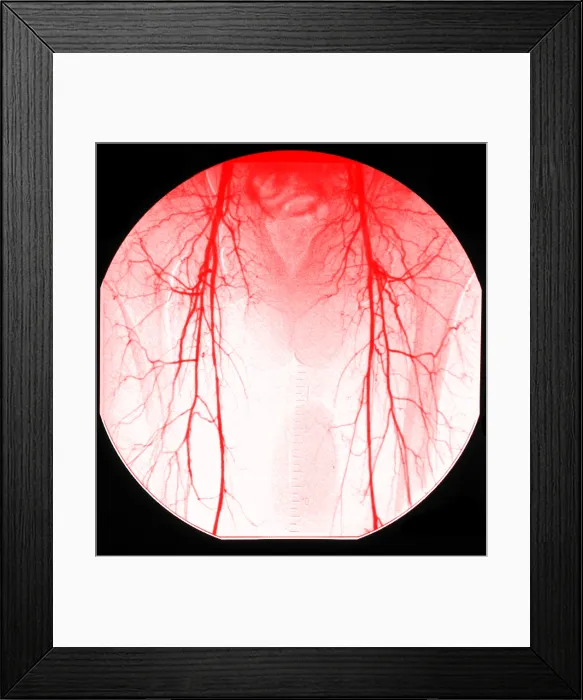 Framed Print : Aortic Angiogram Framed Print : Aortic Angiogram