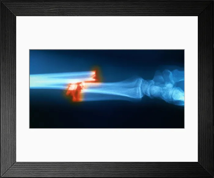 Framed Print : Broken Arm, X-ray