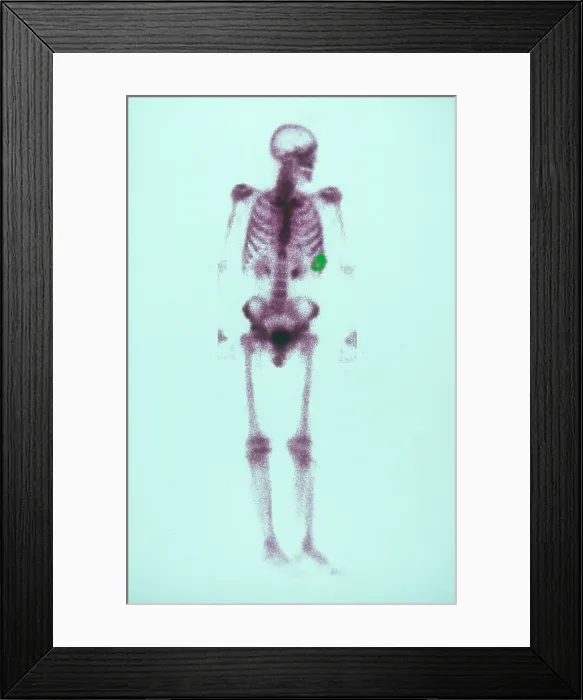 Framed Print : Chondrosarcoma Framed Print : Chondrosarcoma