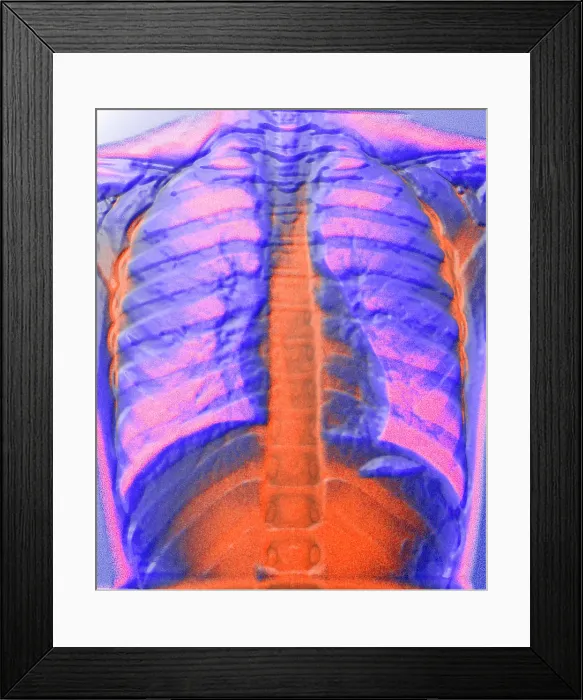 Framed Print : A normal chest X-ray Framed Print : A normal chest X-ray