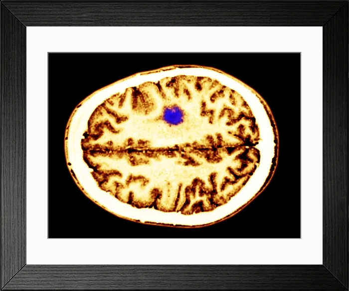 Framed Print : Glioma brain tumor Framed Print : Glioma brain tumor