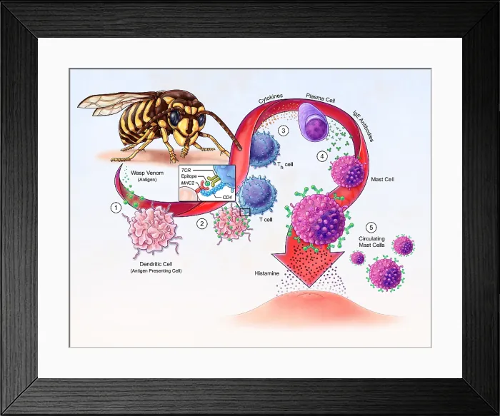 Framed Print : Allergy Development, illustration Framed Print : Allergy Development, illustration