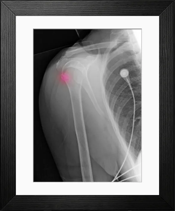 Framed Print : Upper Humerus Fracture, Osteoporosis Framed Print : Upper Humerus Fracture, Osteoporosis