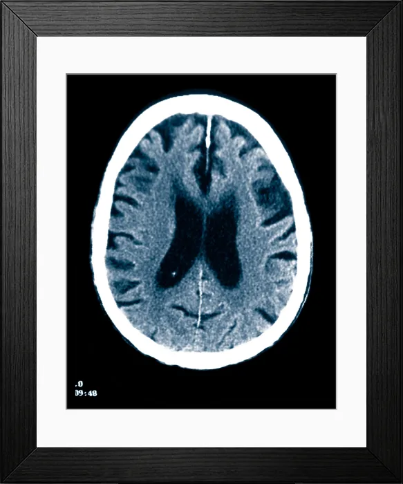 Framed Print : Brain of Alzheimer's Patient, CT Scan Framed Print : Brain of Alzheimer's Patient, CT Scan