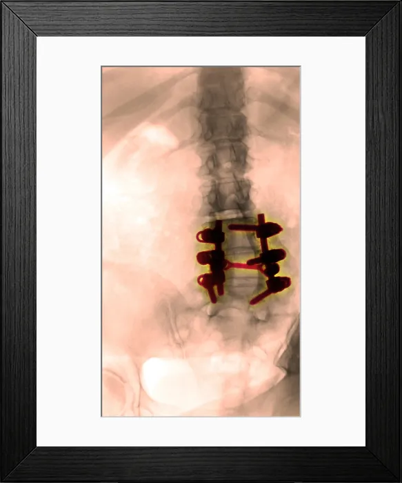 Framed Print : Spinal Fusion Framed Print : Spinal Fusion