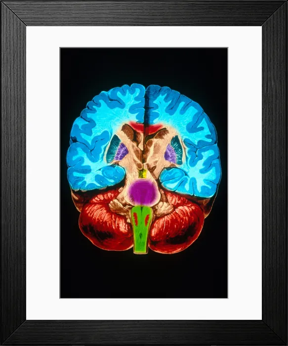 Framed Print : Brain, Coronal Section Framed Print : Brain, Coronal Section