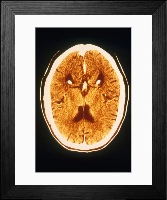 Framed Print : Brain, CT Scan Framed Print : Brain, CT Scan