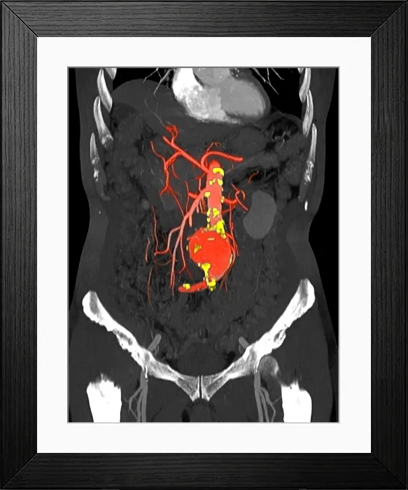 Framed Print : CT Scan of Abdominal Aortic Aneurysm