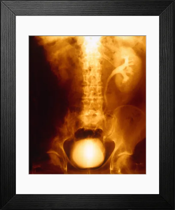 Framed Print : Blocked, Dilated Uterer (Kidney Stone) Framed Print : Blocked, Dilated Uterer (Kidney Stone)