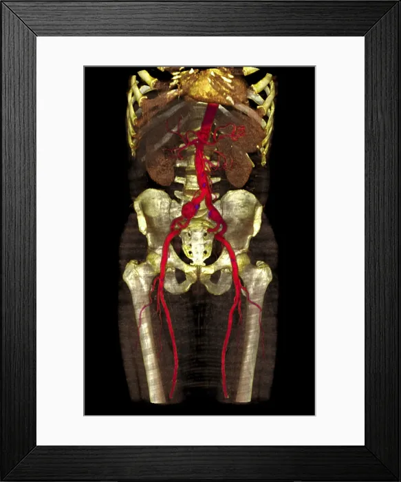 Framed Print : Aneurysm. Lower limb angio CT of a patient with atherosclerotic changes Framed Print : Aneurysm. Lower limb angio CT of a patient with atherosclerotic changes