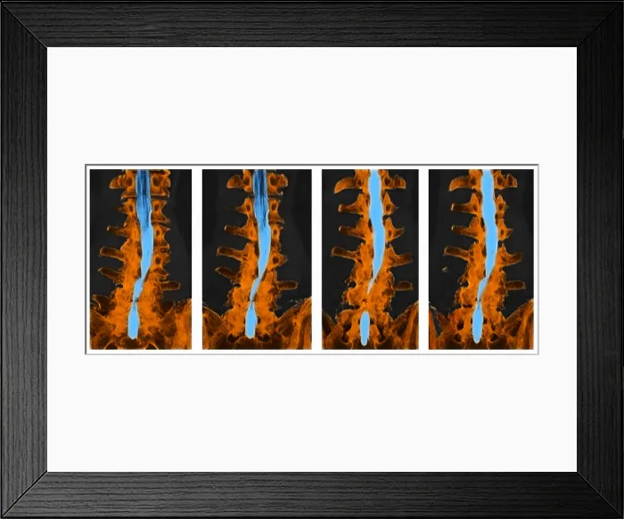 Framed Print : Spine, CT Scan Framed Print : Spine, CT Scan